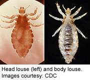 Resistant strain of head lice prevalent in north america