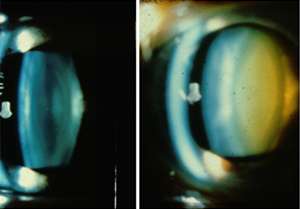 Software to grade cataracts could lead to improved management