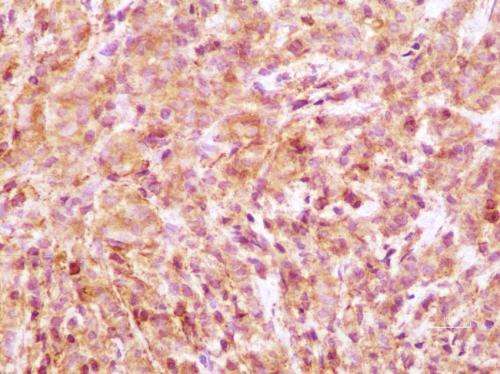 Some breast cancer tumors hijack patient epigenetic machinery to evade drug therapy