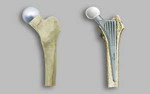 Some patients may benefit from hip resurfacing over replacement