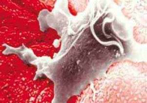 STD may heighten risk of prostate cancer