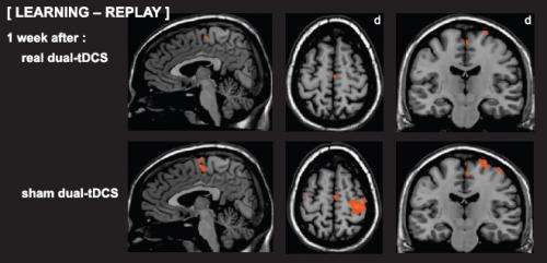 Stroke: Promising results of an important study published in the scientific journal Brain