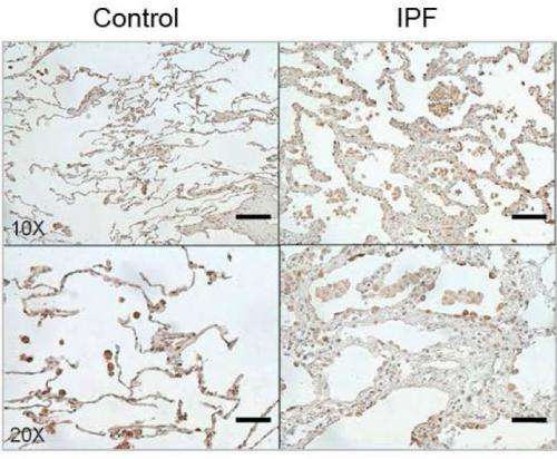 Study IDs 'master' protein in pulmonary fibrosis