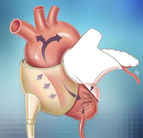 Study: New device can slow, reverse heart failure