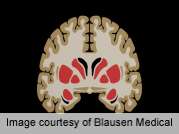 T2DM-linked hypoglycemia doesn't impact brain pathology