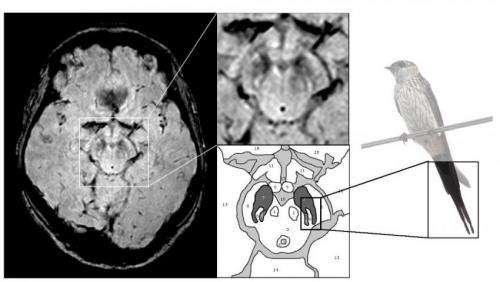 'Tell-tail' MRI image diagnosis for Parkinson's disease