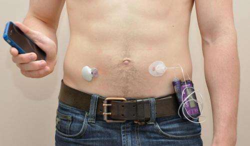 The artificial pancreas shown to improve the treatment of type 1 diabetes
