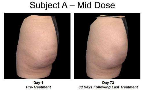 Clinical trial of Auxilium’s Xiaflex shows it to be effective in smoothing cellulite