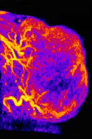 UNC scientists discover hidden subpopulation of melanoma cells