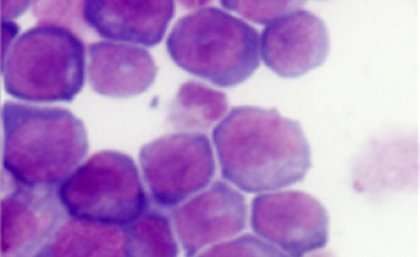 UQ research may lead to drug to fight leukaemia