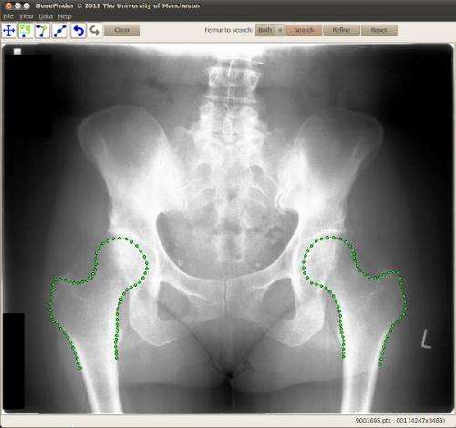 Software to automatically outline bones in X-rays