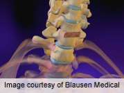 Wrong-level localization in spine surgey rare but still occurs