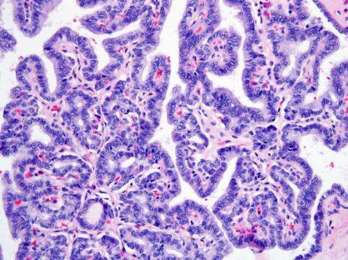 Thyroid cancer genome analysis finds markers of aggressive tumors