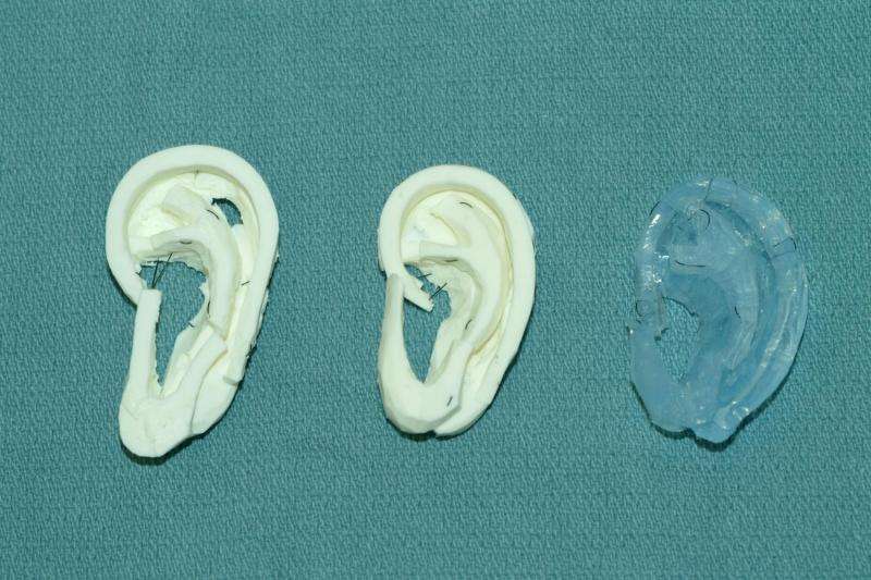 3-D printing techniques help surgeons carve new ears