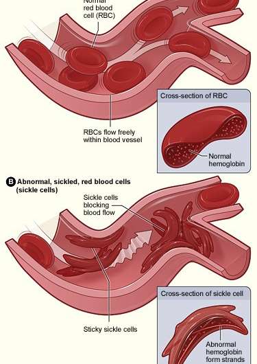 An easy test for sickle cell disease
