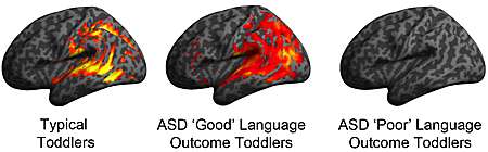 Brain imaging explains reason for good and poor language outcomes in ASD toddlers