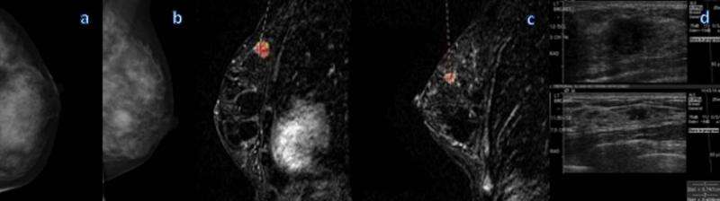 Breast MRI after mammography may identify additional aggressive cancers
