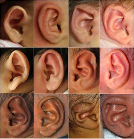 Doctors nonsurgically correct infant ear deformities