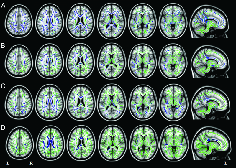 Imaging test may identify biomarker of Alzheimer's disease