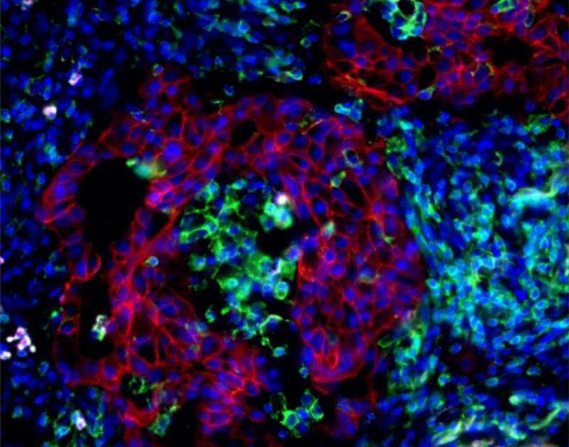 Immune cells in lung cancer offer new drug targets
