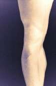 荟萃分析:外翻膝关节支具有助于膝关节骨性关节炎的疼痛