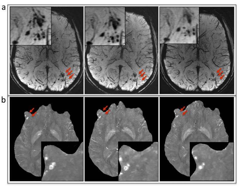 MRI improves diagnosis of microbleeding after brain injury in military personnel