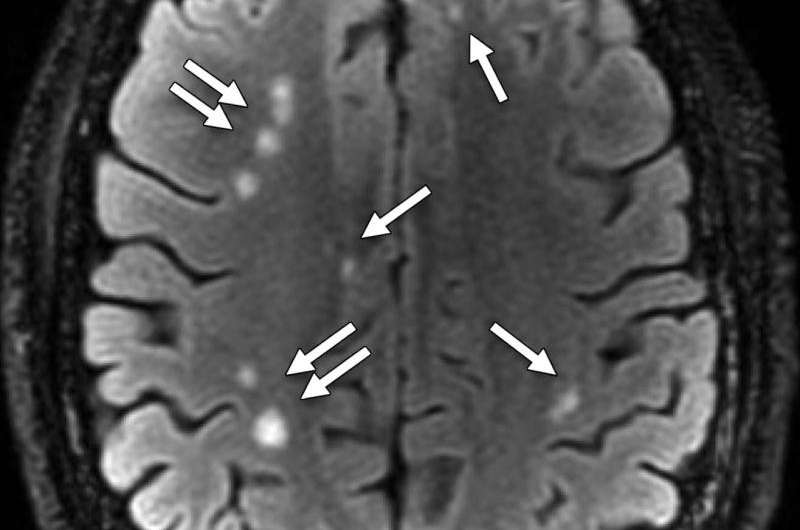 MRI shows 'brain scars' in military personnel with blast-related concussion