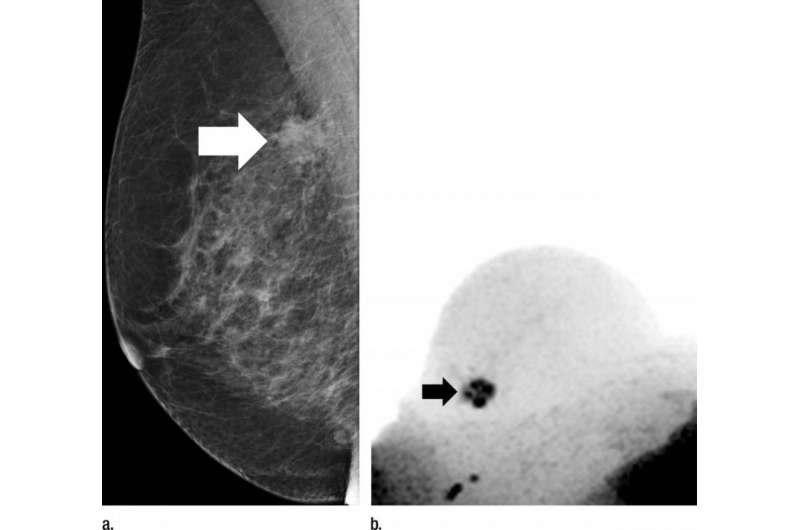 MRI technique could reduce need for breast biopsies
