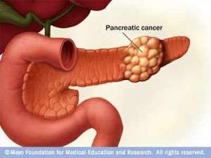 Only 1 in 5 US pancreatic cancer patients get this key blood test at diagnosis