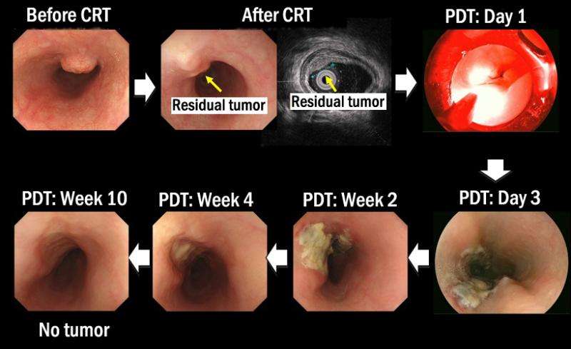 Photodynamic therapy for persistent/recurrent esophageal cancer using Laserphyrin and semiconductor laser