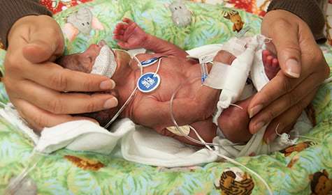 Premature birth appears to weaken brain connections