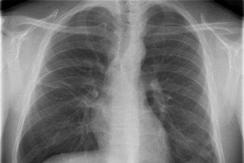 Research could be life-prolonging for cystic fibrosis patients
