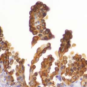 研究人员针对2个基因引发最严重形式的卵巢癌