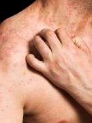 Self-reported eczema valid for detecting atopic dermatitis