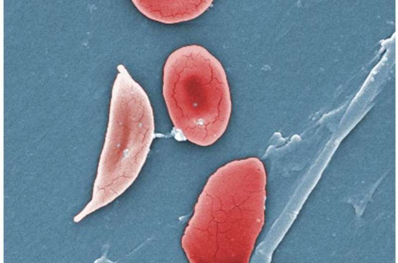 Sickle cell target could treat COVID thumbnail