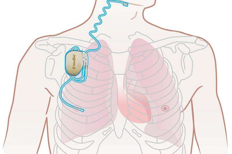 Sleep apnea therapy treats patients through upper airway stimulation
