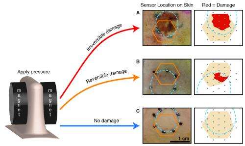 'Smart bandage' detects bed sores before they are visible to doctors