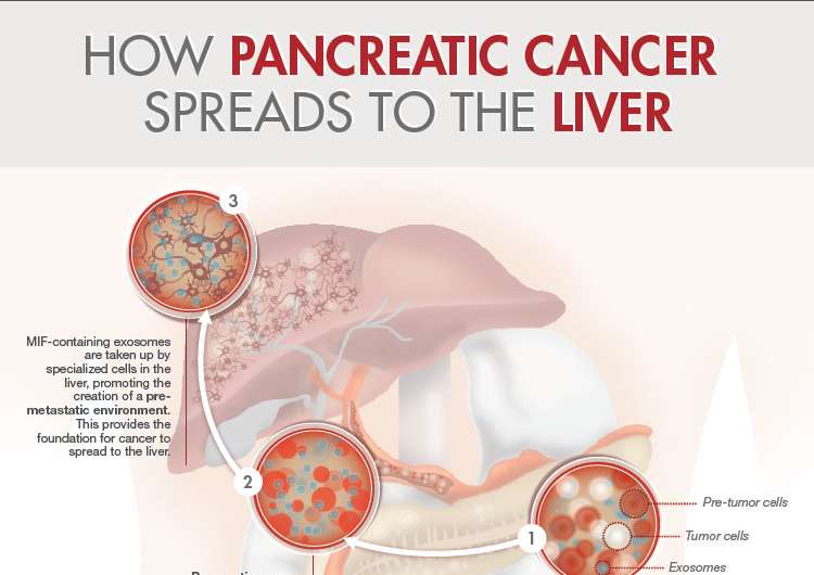 pancreatic cancer with liver mets remedii pentru condiloame