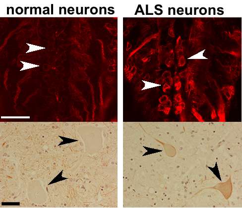 The molecular biology behind ALS