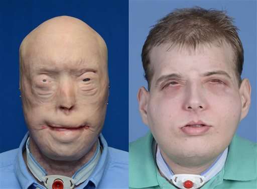 Transplant gives new face, scalp to burned firefighter