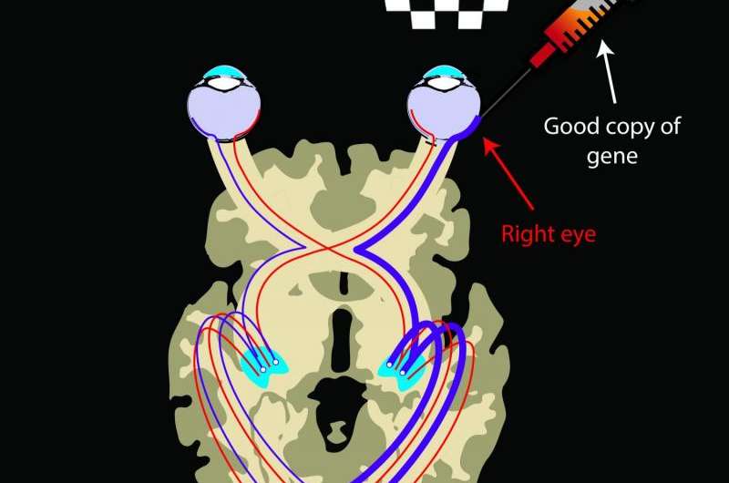 Vision-restoring gene therapy also strengthens visual processing pathways in brain