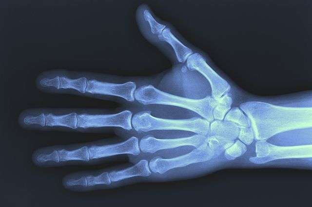 手腕骨折可以预测敏感性在绝经后妇女严重骨折