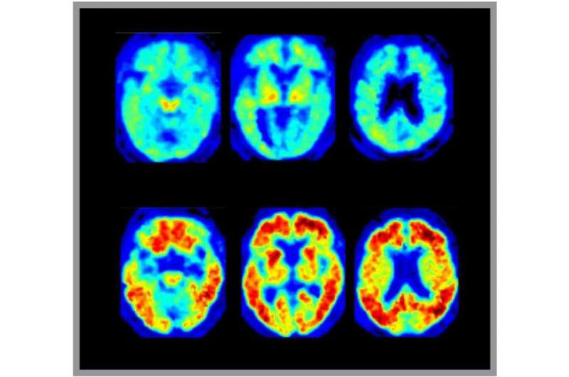 Research seeks to enhance understanding of how Alzheimer’s Disease develops