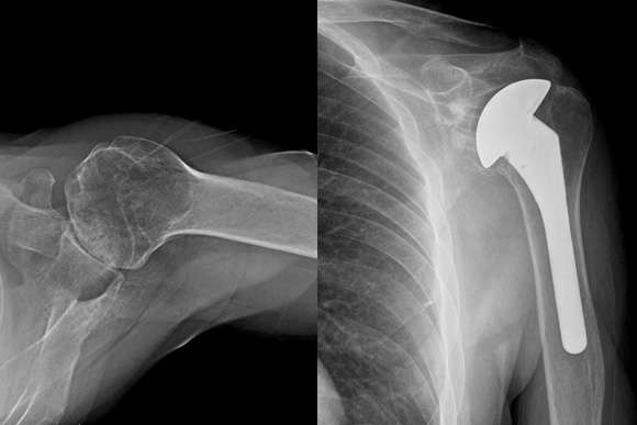 New technology helps surgeon build a better shoulder