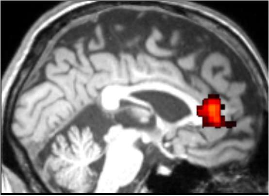 Brain scan reveals cognitive deficits in older 'cognitively normal' HIV+ individuals