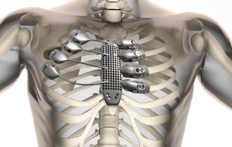 Cancer patient receives 3-D printed ribs