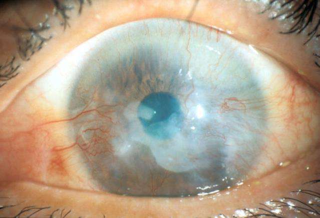 Cells transplanted from mouth can be used to treat illnesses causing blindness