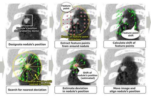 Fujitsu develops technology to accurately align nodules within CT scan images taken over time