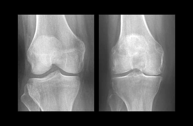 Low vitamin D linked to osteoarthritis in the knee