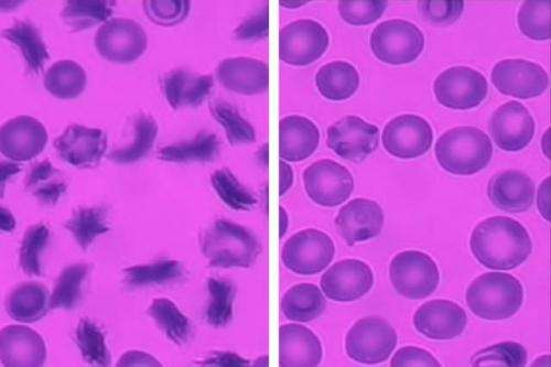 Microfluidic device allows researchers to predict behavior of patients’ blood cells